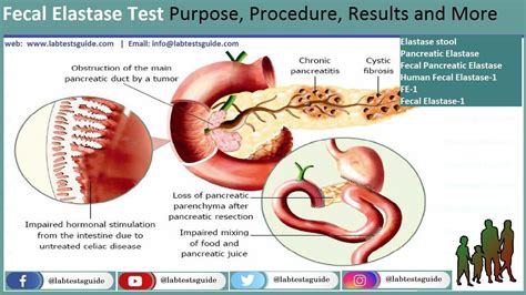 elastaza pancreatica in materii fecale|Elastaza pancreatică în materii fecale